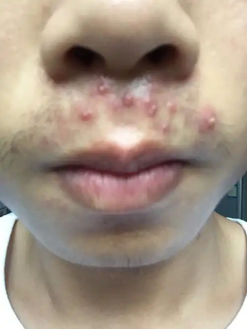 这些白色的脓包能挤掉吗?