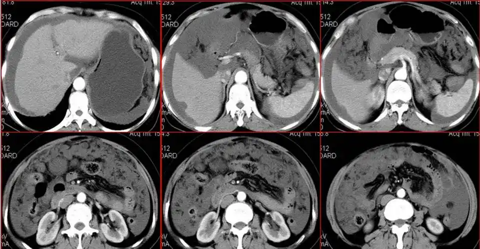 腹水介绍_腹水病因_腹水治疗_腹水医院医生_有来医生