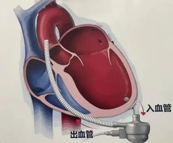 59岁阿叔装上国产"人工心脏"获得"重生"