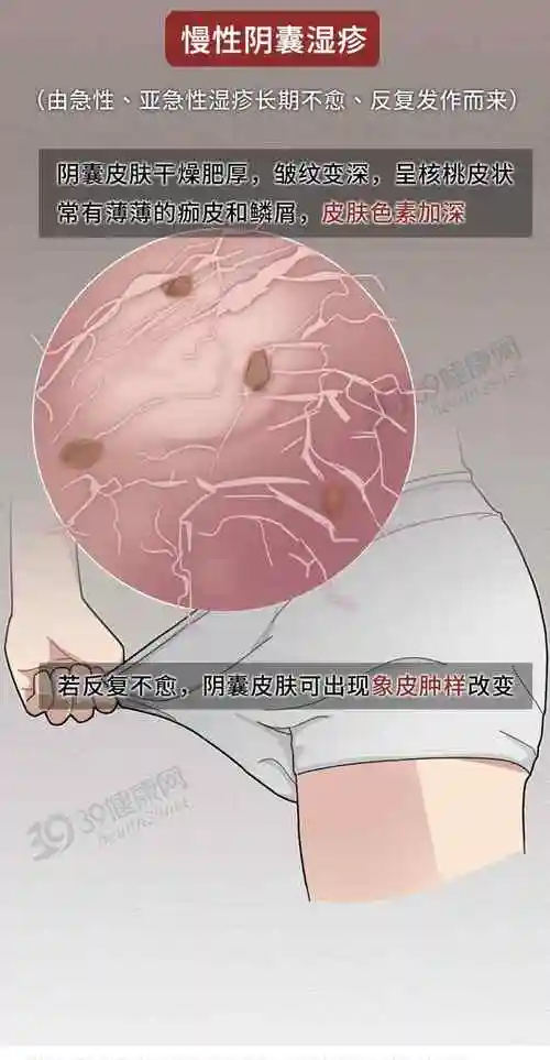 为什么脖子湿疹阴囊湿疹