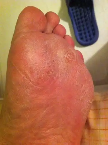 《备急千金要方》云:"脚气"一说,古已有之,却非今人所谓之"脚癣"红色