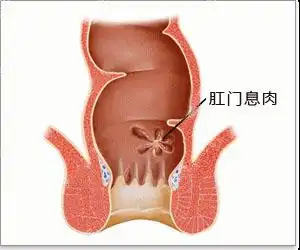 肛门息肉百科