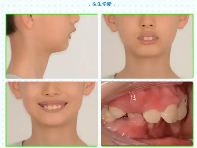 9岁孩子下巴后缩,现在用不用矫正?