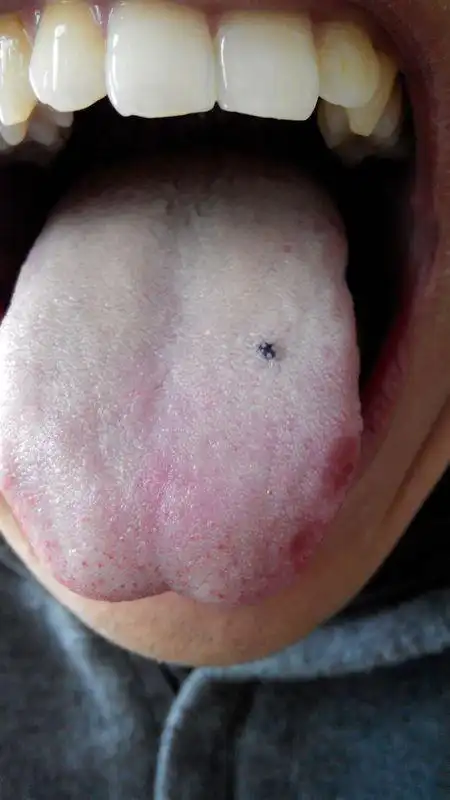 舌头上长了黑色的疙瘩