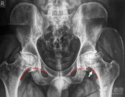 提示存在着髋关节轻度的半脱位.