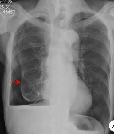 气胸的典型影像学表现 - 好大夫在线