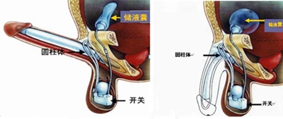治疗阳痿最好的办法-阴茎起搏器