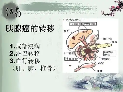 第五节胰腺癌病人的护理ppt