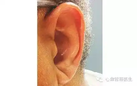 权威研究提示:耳垂折痕高度警示心脏病