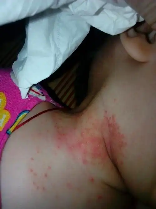 小孩脖子上长的是什么