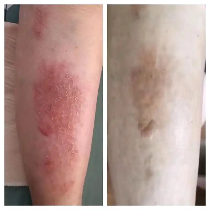 科普 #皮肤病 本院案例图小腿部位如果出现有湿疹,一般