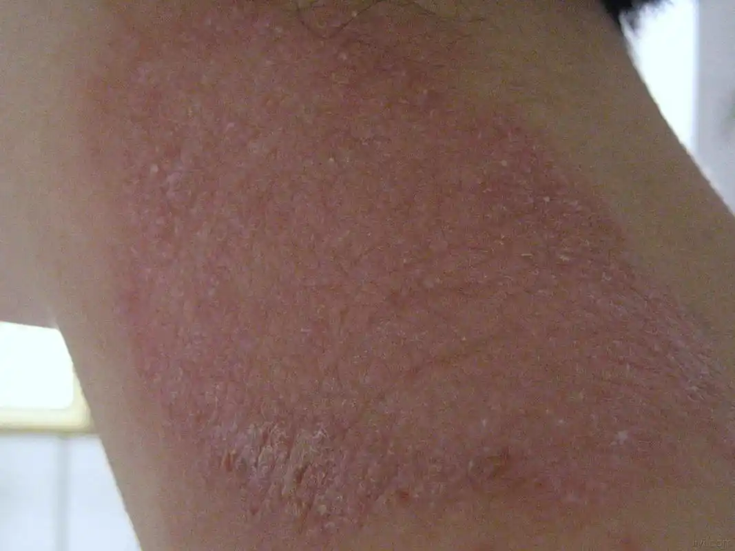 这位患者,脖子上皮肤很痒,以为是癣,涂抹了达克宁    结果越涂越大