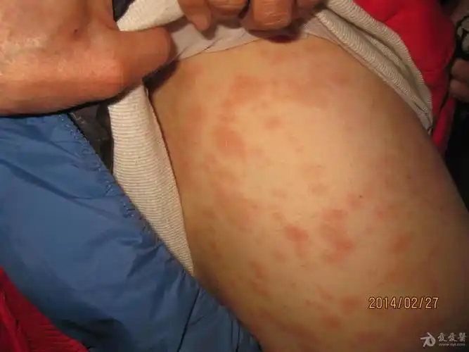 泛发性玫瑰糠疹1例