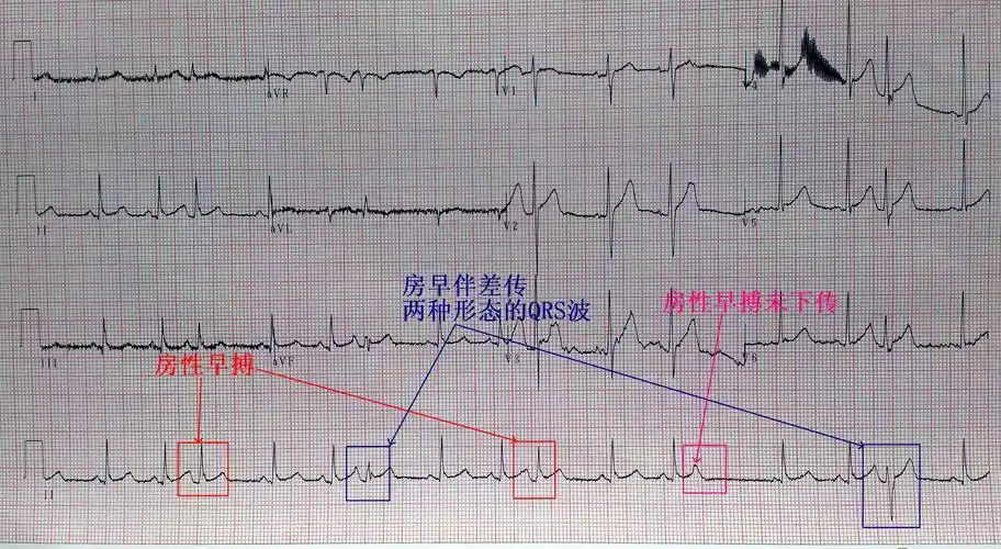 欣赏心电图-17(房性早搏)
