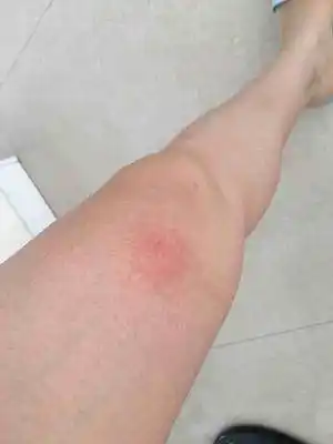 大腿上突然肿了一块