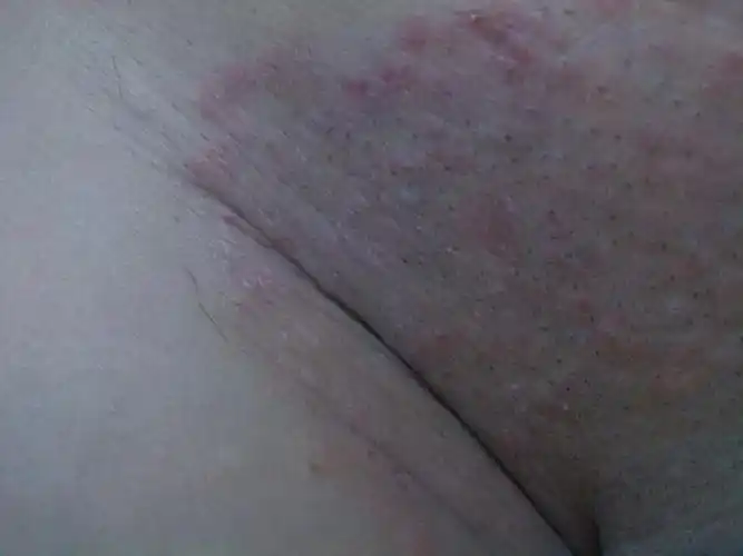 屁股也有,以为是毛囊炎,但用莫匹罗星软膏后没有明显效果.