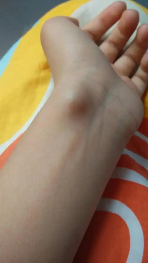 腱鞘囊肿.这个样有什么办法消除除了做手术!它已经长了半年了.