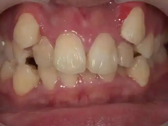 日本人牙齿普遍难看,这背后问题,父母们要重视了