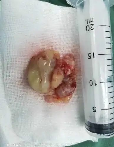 李健东大夫 的想法: 鼻腔肿瘤,戴医生在内窥镜下完美切除 - 知乎