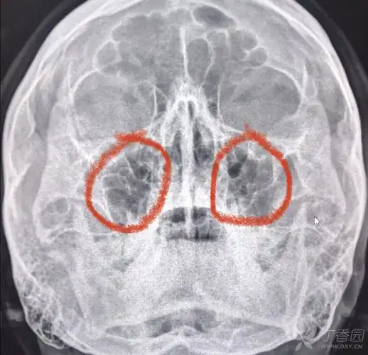 头疼摄影副鼻窦