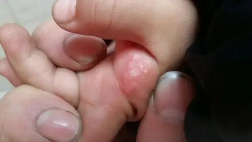 孩子2周岁2个月了手上起了点透明小泡泡一小片