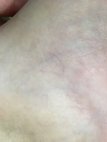 脚内侧的毛细血管,请问这是静脉曲张吗