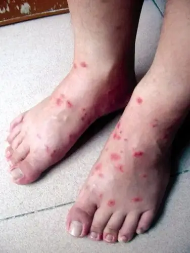 被蚂蚁咬了几口厦门一男子突然晕倒甚至出现昏迷天热了去这些地方千万