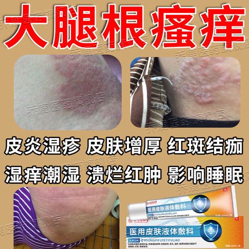 内廷上用  大腿根内侧瘙痒皮肤外用专用敷料 去大腿根内侧瘙痒皮炎