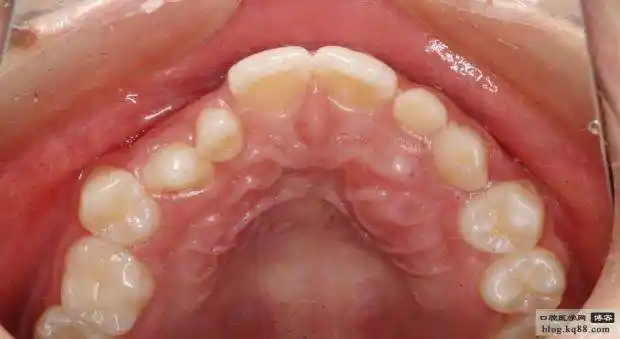 人的上颚有坑坑哇哇的褶皱是起什么作用的?