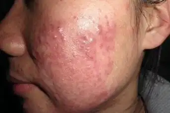 萎缩性青春痘,囊肿性青春痘,聚合性青春痘等多种类型