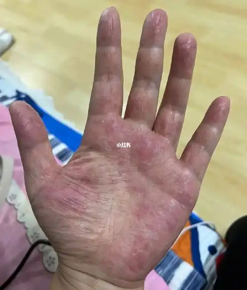 手掉皮(湿疹)的发病机理