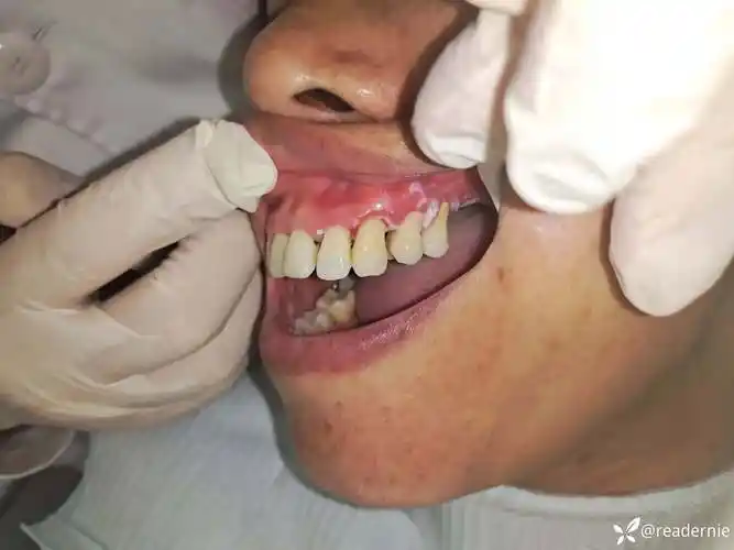 口腔白斑治疗一例