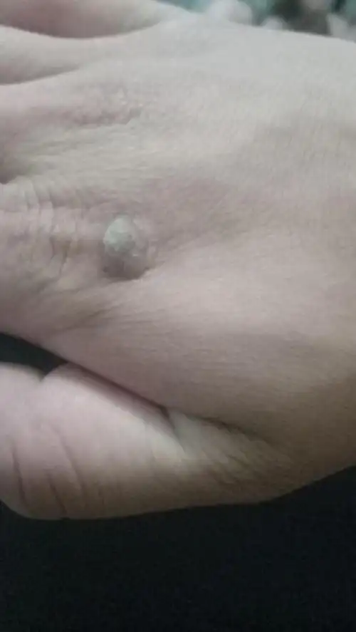 这样的瘊子有什么治疗方法,一直在长…听说激光打了可能会复发?