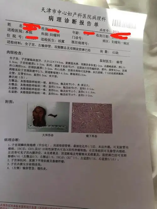 宫颈癌病理报告