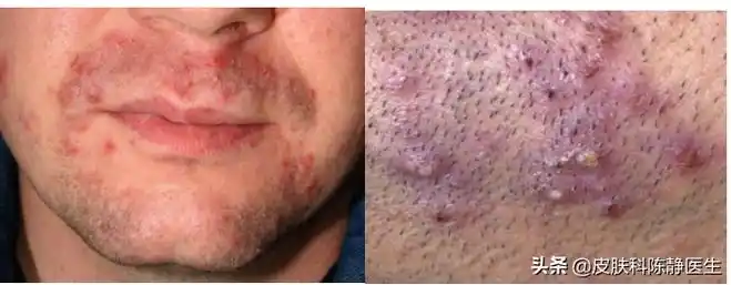 刮胡子发现红疙瘩?你得知道须部毛囊炎及假性毛囊炎