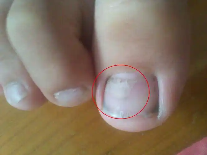 小孩指(趾)甲变形,双层中间空,如图,是什么引起的,怎样治疗,以后有