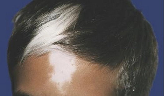 这种情况通常出现在双侧或单侧型白癜风,表现为白斑内毛发逐渐变白,在