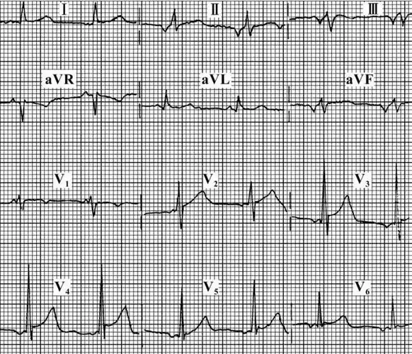 特殊的房性心律