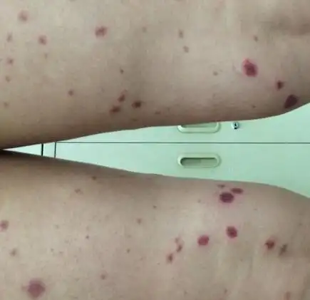 混合性过敏性紫癜传染吗?过敏性紫癜症状