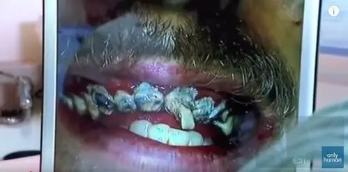 20年不刷牙?后果竟是如此触目惊心!