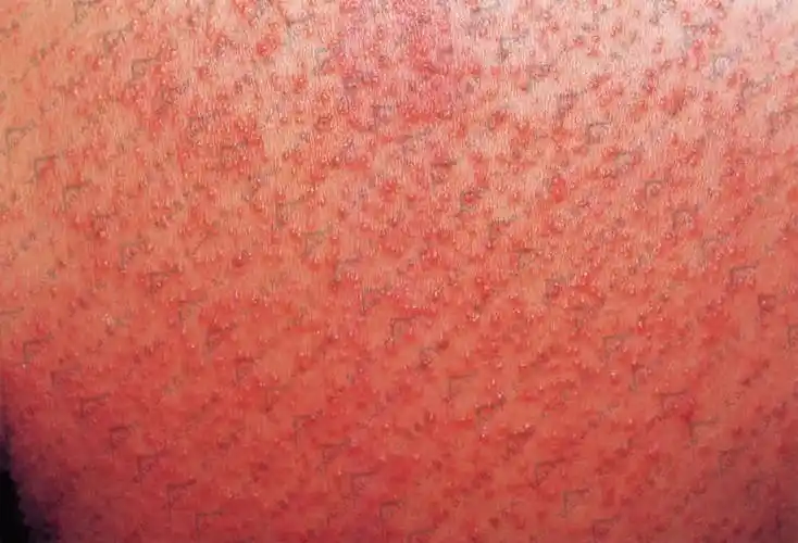 起痱子(白痱,红痱,脓痱,深痱)原因,症状与治疗 - 皮肤病学 - 天山医学