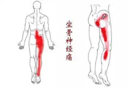 日常生活坐骨神经疼痛可以这样缓解和调理