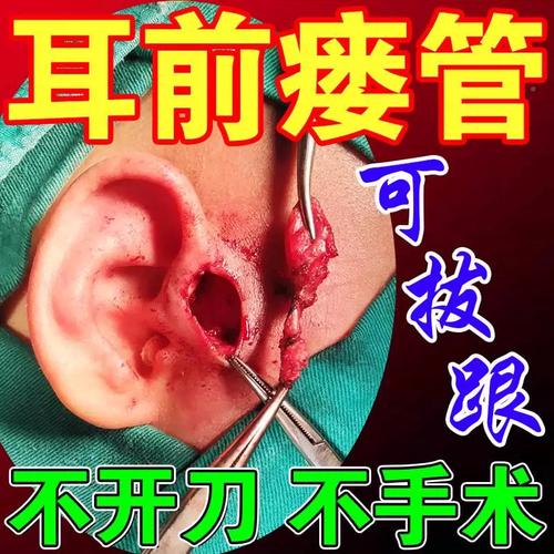 耳前瘘管药膏耳仓消炎发炎红肿疼痛鼓包异味先天性中耳炎流脓滴液