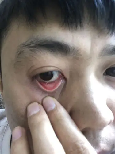 下眼皮内侧张两颗小小的白色肉粒