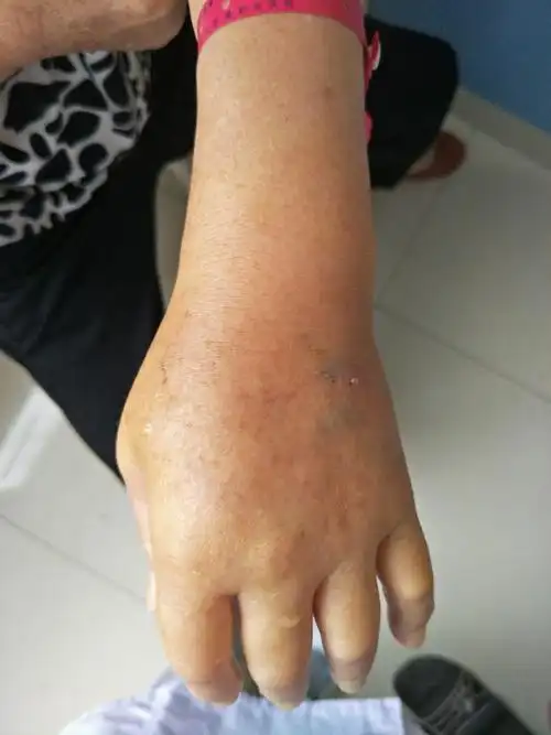 药物外渗皮肤变化及处理.(副本)