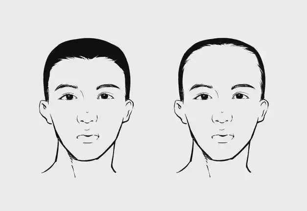 发际线秃了,还有救吗?