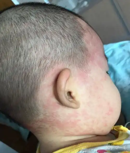 啊可恶的幼儿急疹