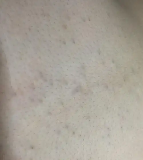 肚子上有这样的黑斑是怎么回事?