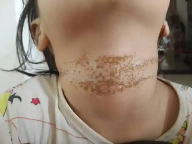 (图)脖子,一开始以为是痱子,给小孩上粉,现在大概有15天到20天了.