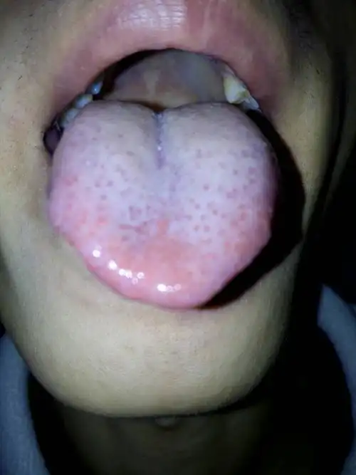 看图,舌头上有一点点红点怎么回事呢?